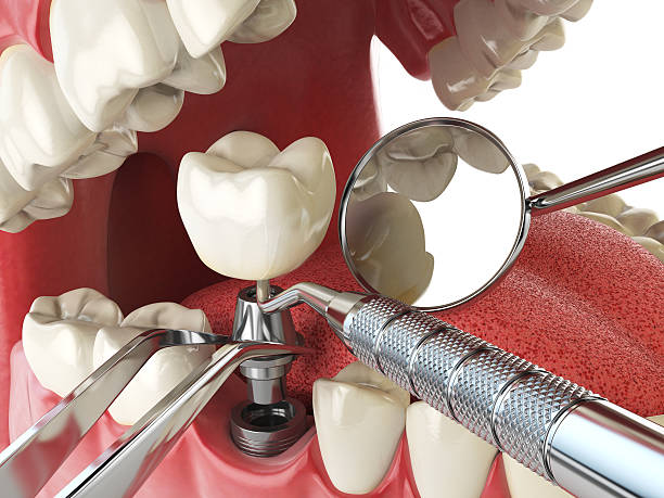Best Emergency Wisdom Tooth Extraction in Cove Creek, NC